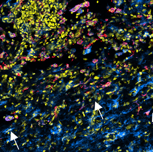 Macrophages change phenotypic markers (blue to pink colors) when confronted by glioma cells (yellow)